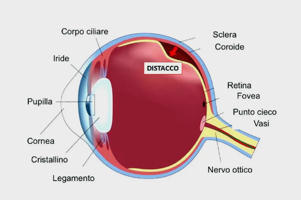 Patologie Oculari Como - Distacco della Retina
