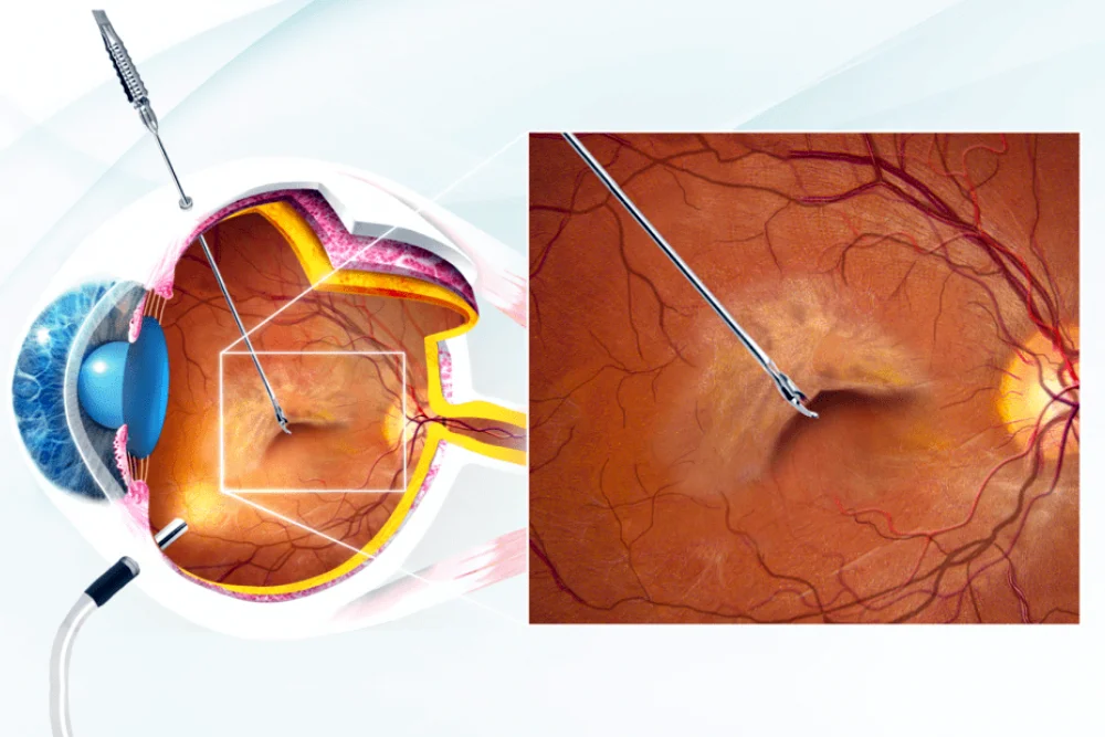 Patologie Oculari Como - Membrana Epiretinica - Pucker