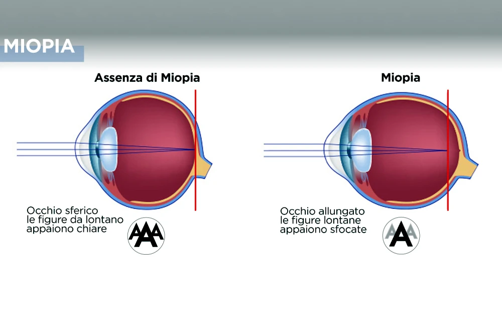 Patologie Oculari Como - Miopia